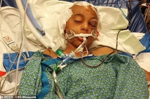 11歲的女孩在下校車時被撞 腦部已進(jìn)行多次手術(shù) 11歲的女孩在下校車時被撞 腦部已進(jìn)行多次手術(shù)